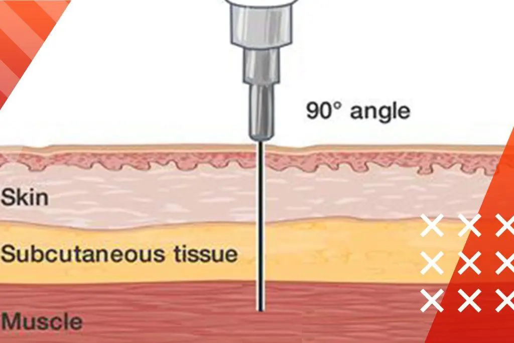 intramuscular injection directional angle