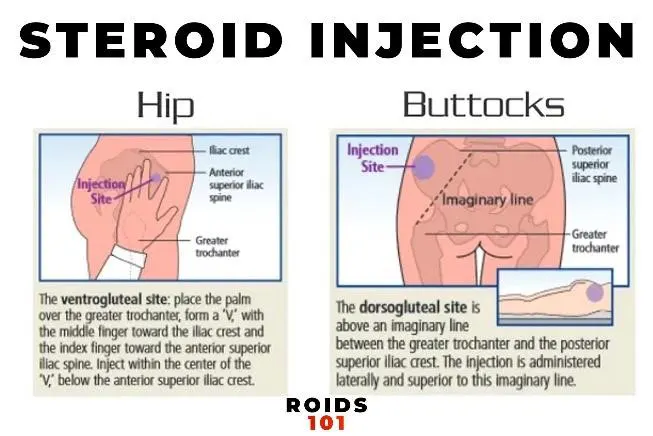 steroid injection hip buttocks